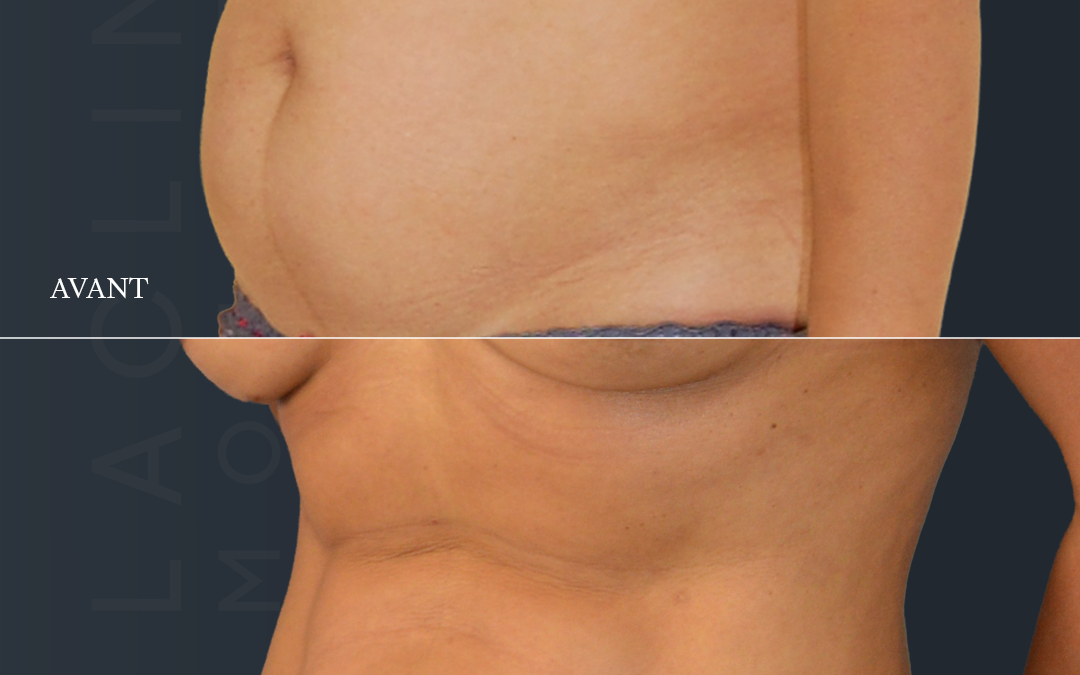 Liposuccion haute définition
