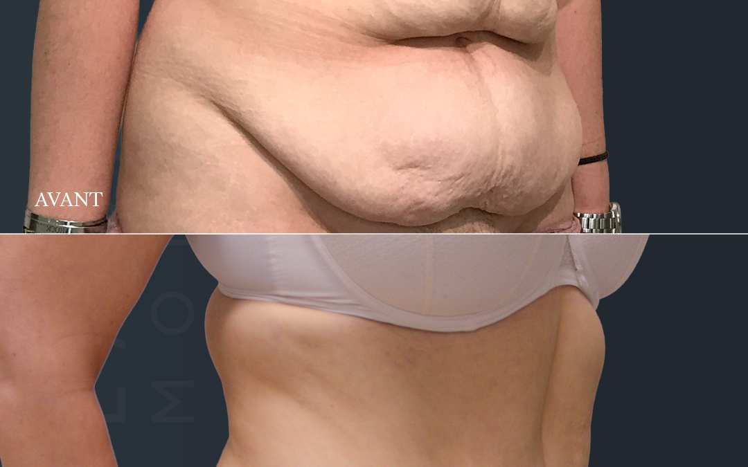 Bodylift