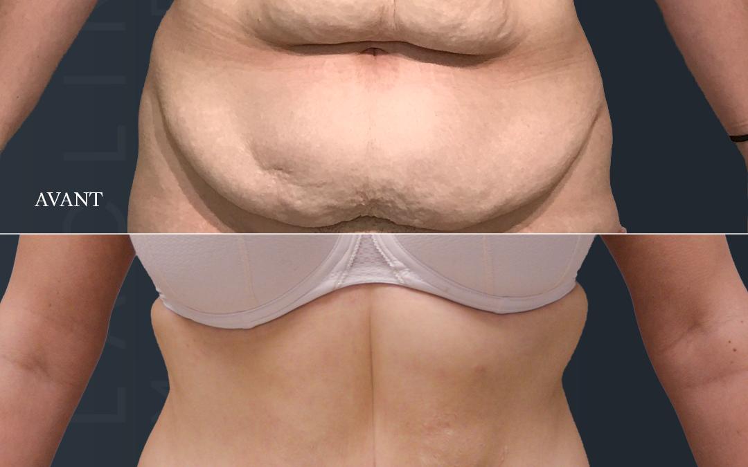 Bodylift