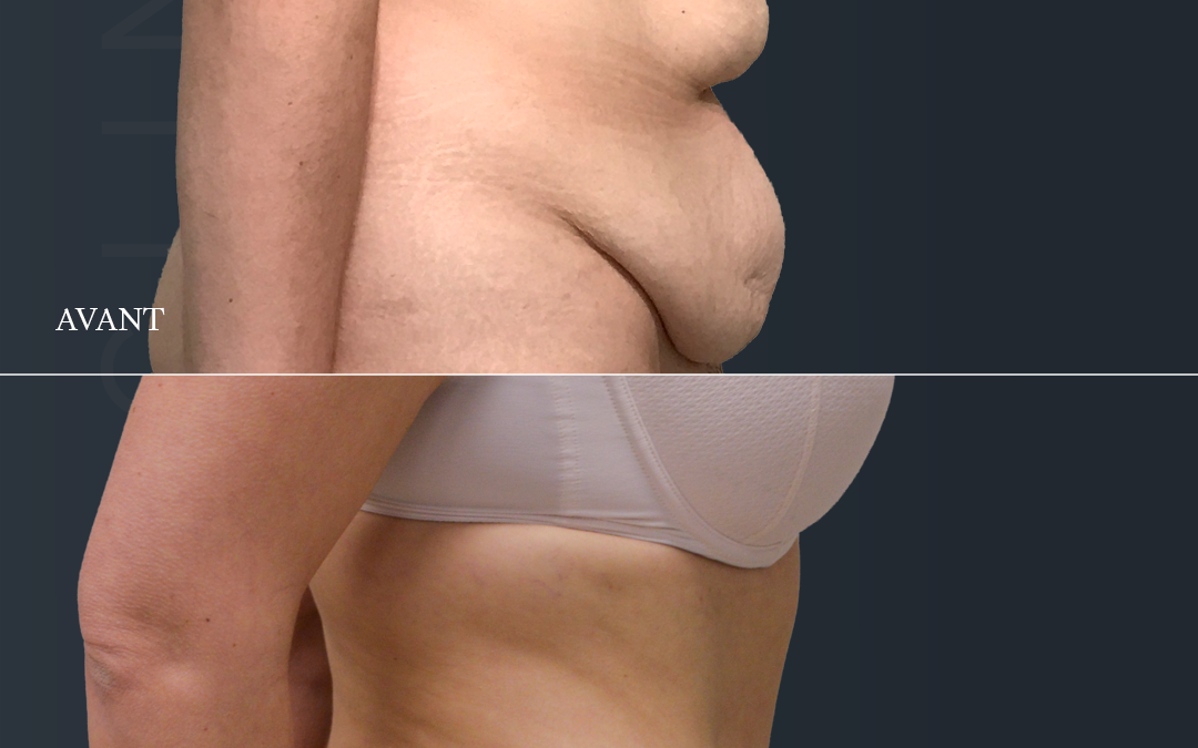 Bodylift