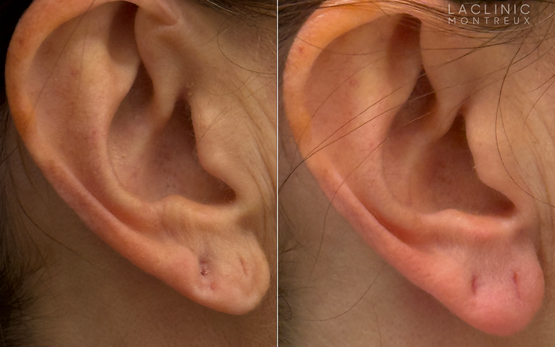Filler acide hyaluronique lobe de l&rsquo;oreille