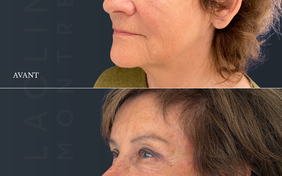 Lifting visageLifting cervico-facial (deep-plane ) + lifting fronto-temporal = ponytail lift