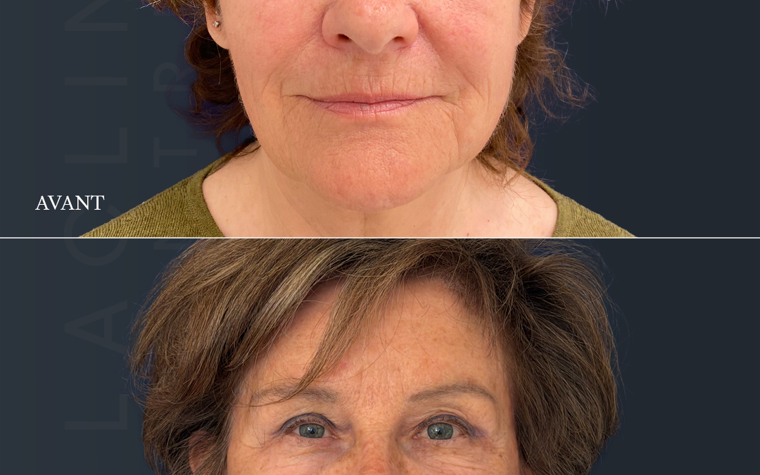 Lifting visageLifting cervico-facial (deep-plane ) + lifting fronto-temporal = ponytail lift