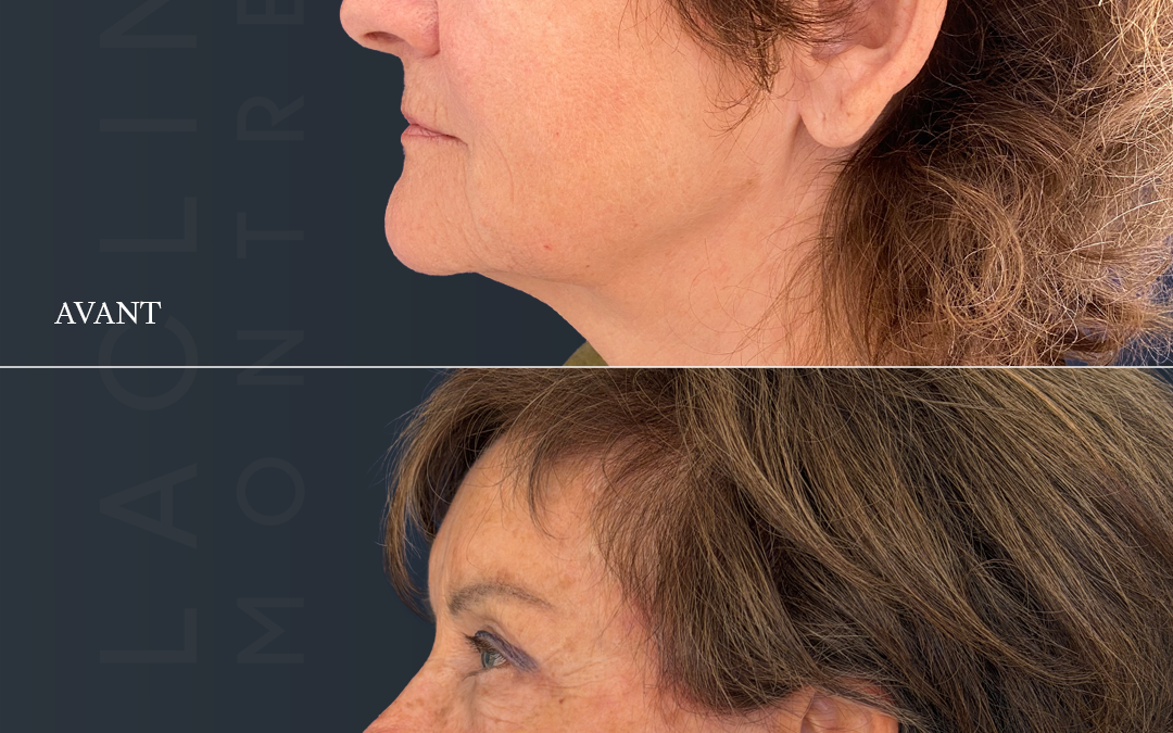 Lifting visageLifting cervico-facial (deep-plane ) + lifting fronto-temporal = ponytail lift