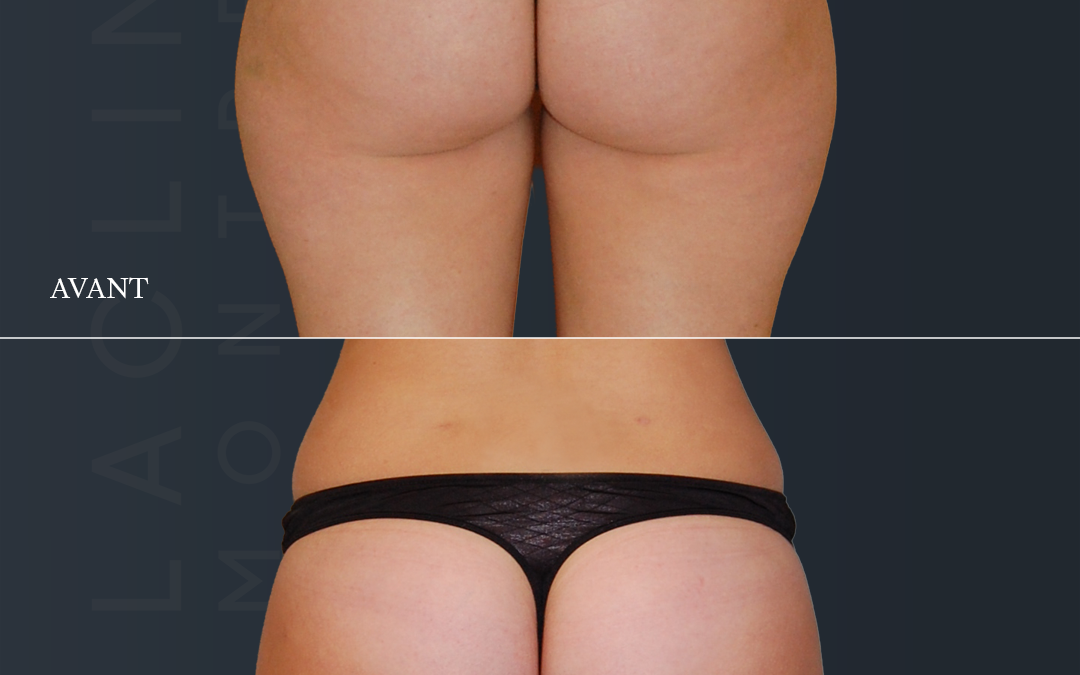 Liposuccion des fesses