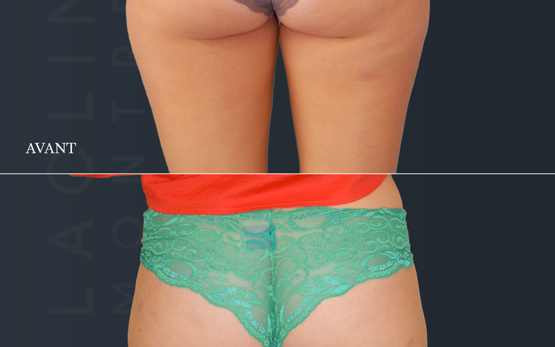 Liposuccion des fesses