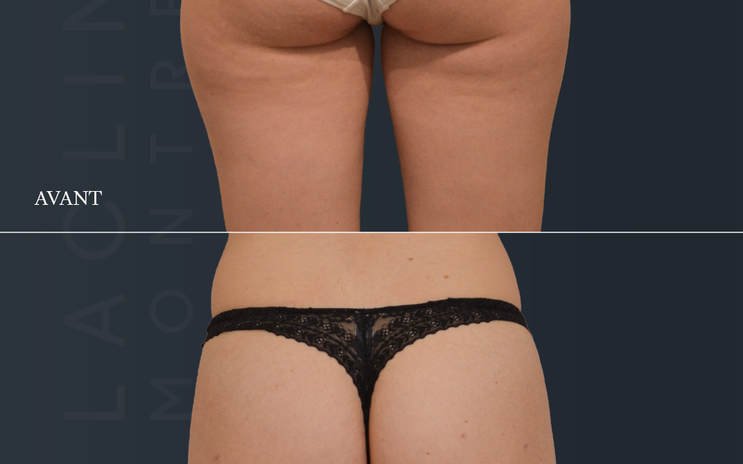 Liposuccion des fesses